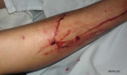 dog bite ten person in shimla.
