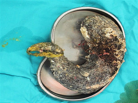 massive hairball of two kg removed from girl's stomach