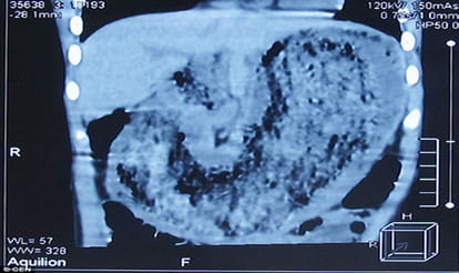 massive hairball of two kg removed from girl's stomach