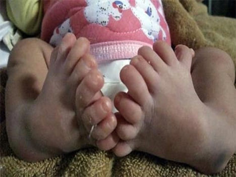 baby with 24 fingers on foot and 32 teeths