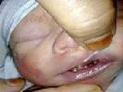 baby with 24 fingers on foot and 32 teeths