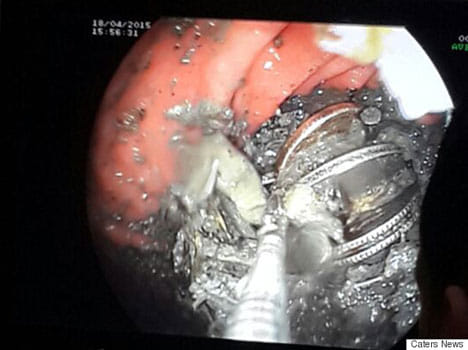 coins inside stomach