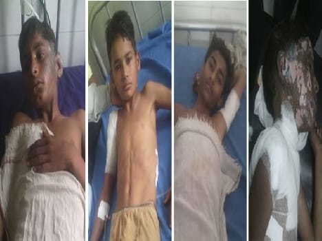 4 children burn by ht line