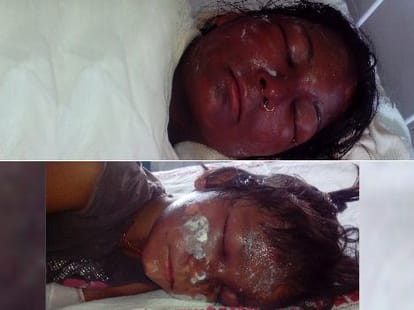 acid attack on wife and daughter, serious injured