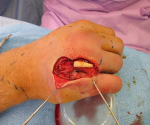 a punch backfired, tooth of brother found inside hand 