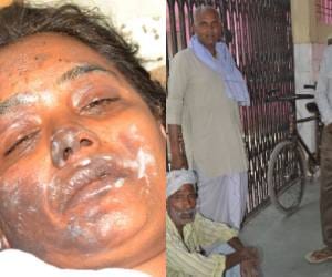 A women set fired by her family members.