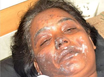 A women set fired by her family members.