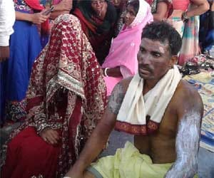 girl married with burnt man