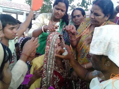 girl married with burnt man