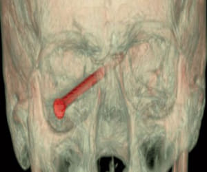 3-Inch Nail Embedded in Eye 