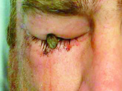 3-Inch Nail Embedded in Eye 