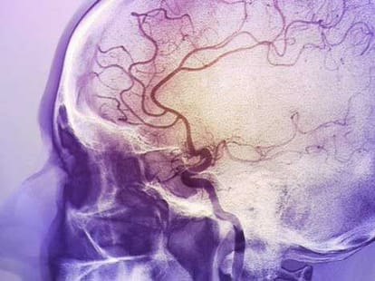 strokes rising in young people
