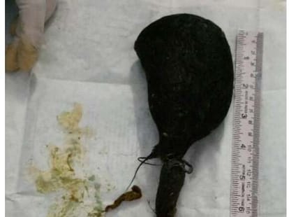 Doctors did a tough operation of a teenaged girl.