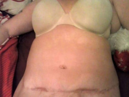 moment when tummy tuck explode