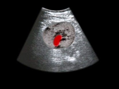 How to Prevent Kidney Stones in summer