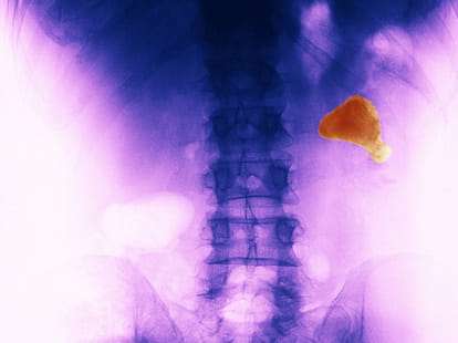 How to Prevent Kidney Stones in summer