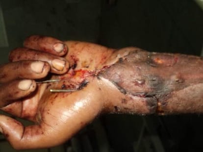 Doctors did a huge surgery in KGMU. 