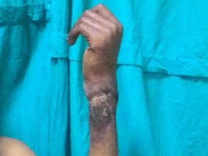 Doctors did a huge surgery in KGMU. 