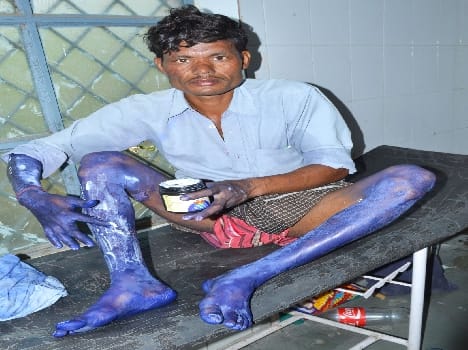 Cylinder leak caught fire, three Scorched
