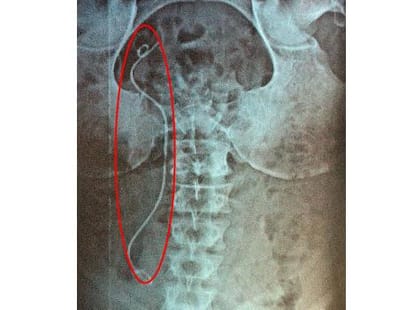 Doctor forget to remove drain pipe after surgery
