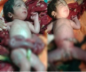 miracal opeartion by pgi rohtak doctors, saved baby life