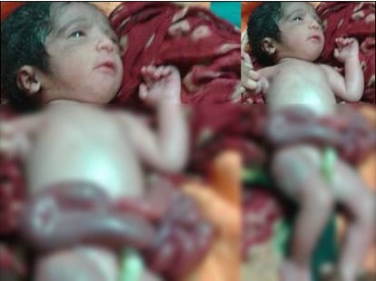 miracal opeartion by pgi rohtak doctors, saved baby life