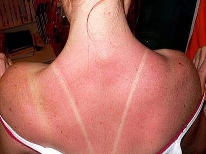 summer health problems 