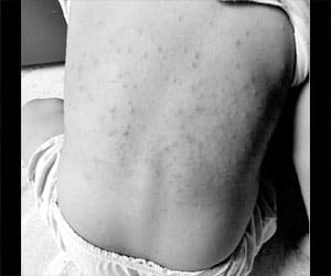 After Maggie becuse of serelek fell marks on the body