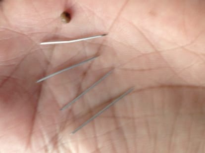 4 month old boy has also 5 needle in his head