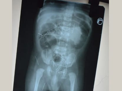 needles found in kids stomach