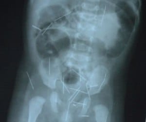 needles found in kids stomach