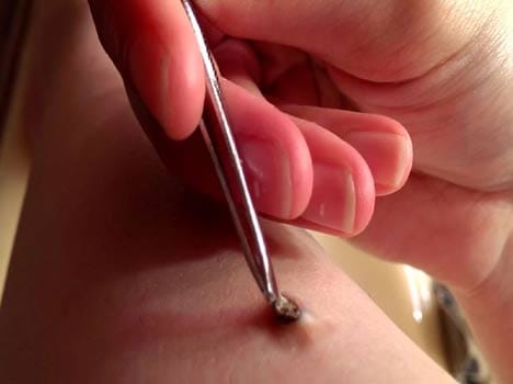 a parasite from her leg with tweezers