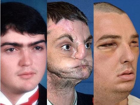 Man with a transplanted face