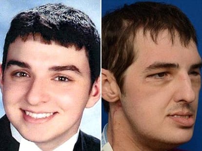 Man with a transplanted face