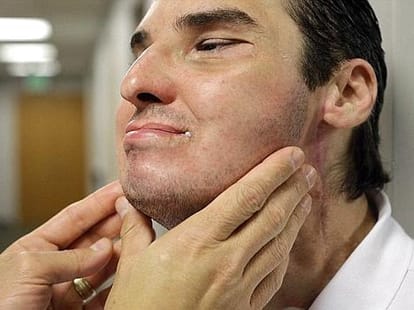 Man with a transplanted face