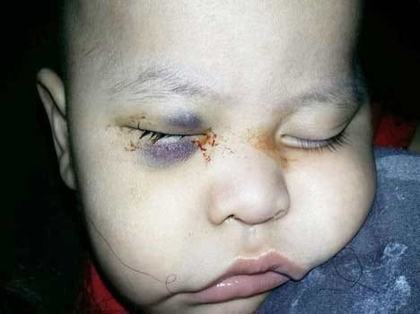surgeon removed the wrong eye of a one year kid