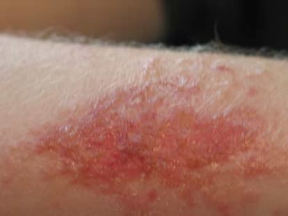 dangerous diseases caused during monsoon season
