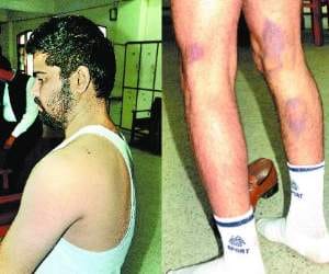 himachal high court orders for medical of accused brutally beaten up by police.