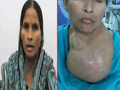 AIIMS doctors create history, the largest tumor removed.