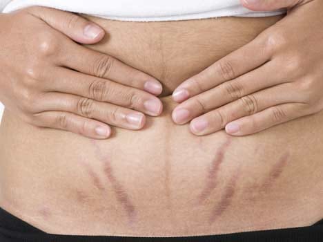home remdies to remove ugly stretch marks