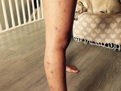 this woman scratches her own skin 
