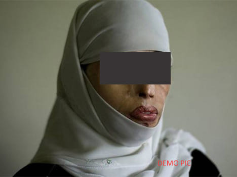 mother in law through acid on daughter in law for dowry in moradabad
