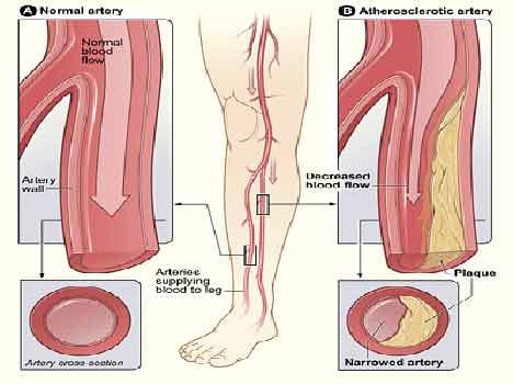 electric plaster to be launched soon that will heal your legs