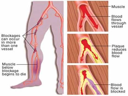 electric plaster to be launched soon that will heal your legs
