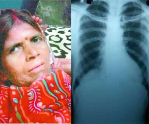 right kidney found in the breast of this lady