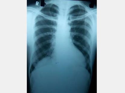 right kidney found in the breast of this lady