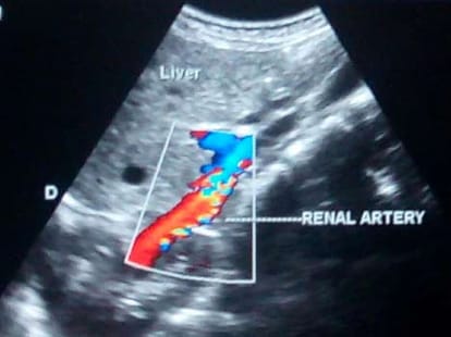 right kidney found in the breast of this lady