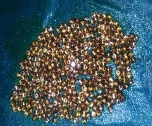 doctors removed 360 galstones from women