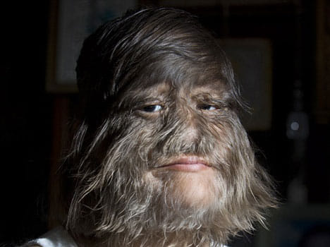 the world's hairiest girl