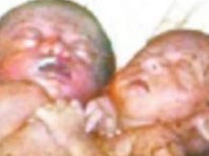 special child born in baharaich